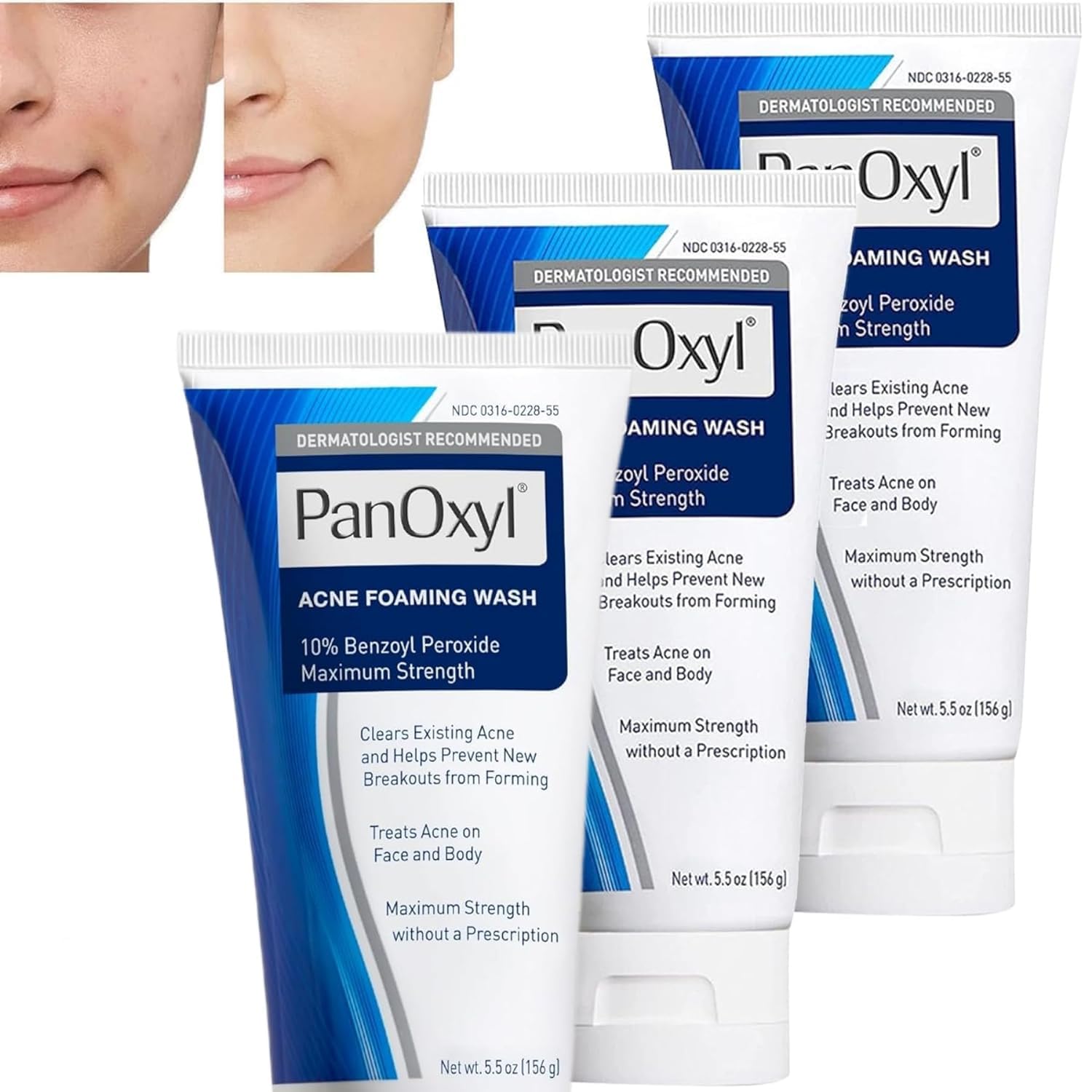 Generic Acne Foam Wash Mild Daily Facial Cleanser for Deep Pore Cleansing, Mild Cleansing for Problem Skin Such as, Cleansing Foam, 156 ml